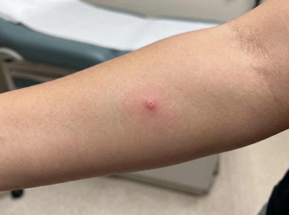 Close-up photo of a fresh false black widow spider bite showing a small red swollen bump with mild surrounding redness on skin