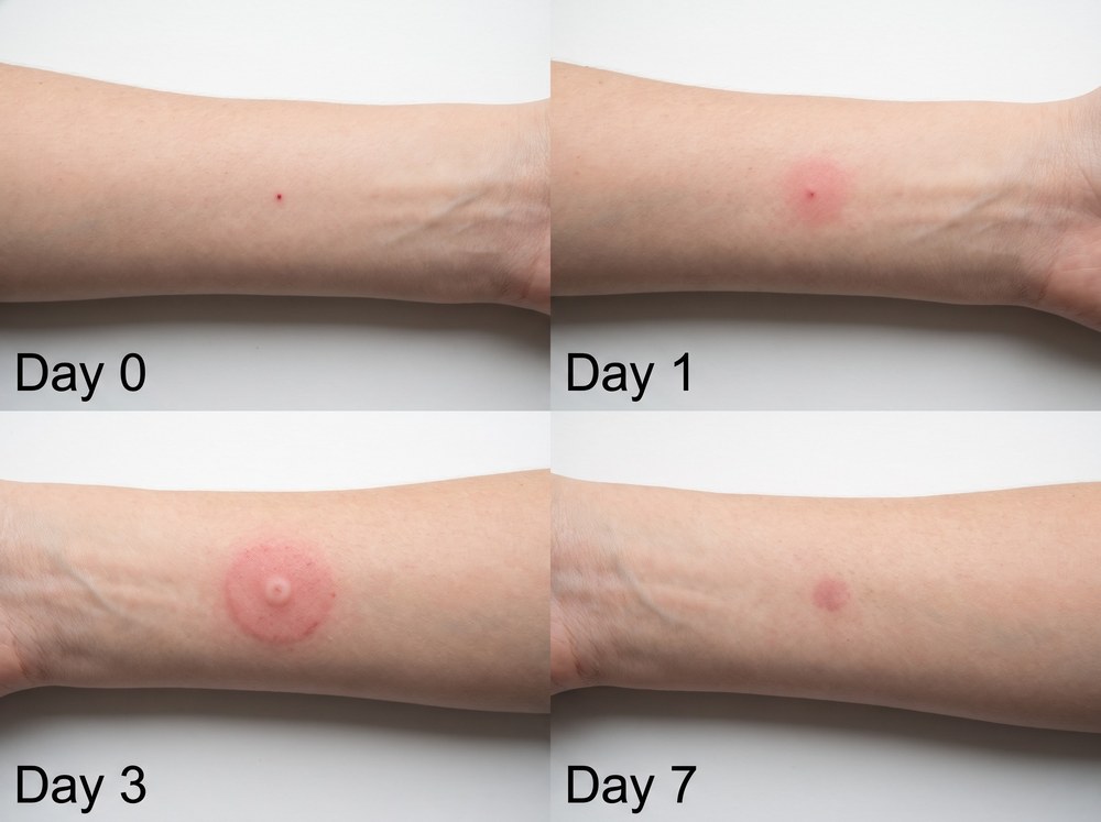 Four-panel photo progression of a false black widow bite healing from Day 0 through Day 7, showing swelling rise and then subside